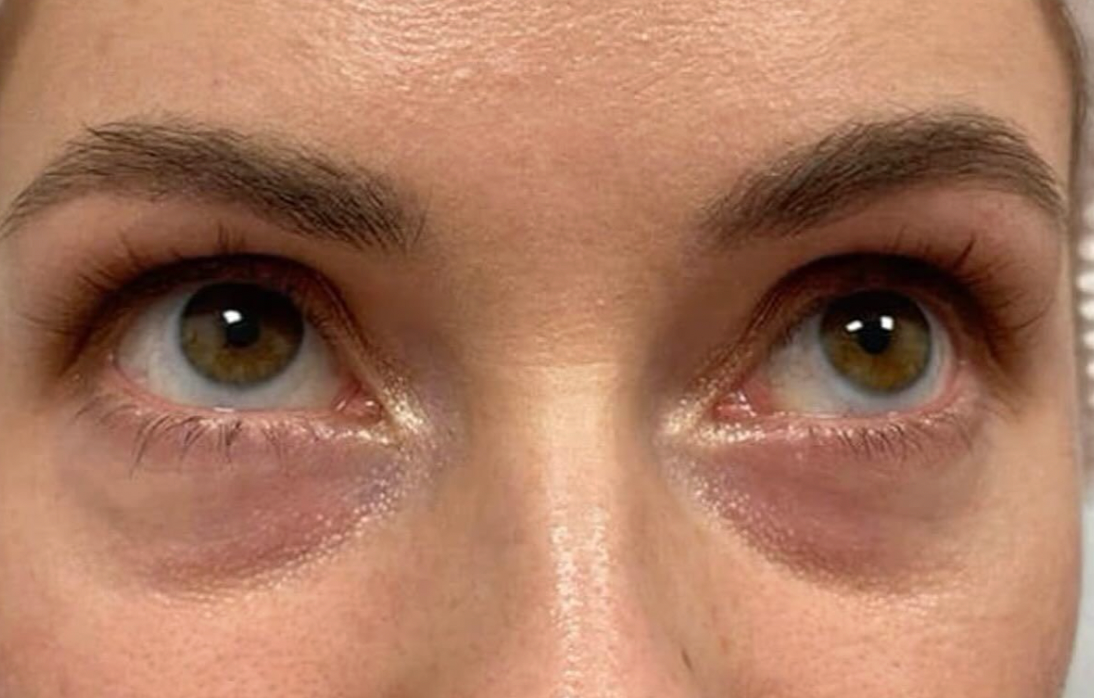 Sunken Eyes from Lash Serum: Can It Happen?